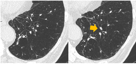 CT image with an arrow pointing to a mucus plug