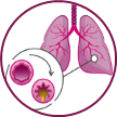 Image of the lungs depicting inflammation