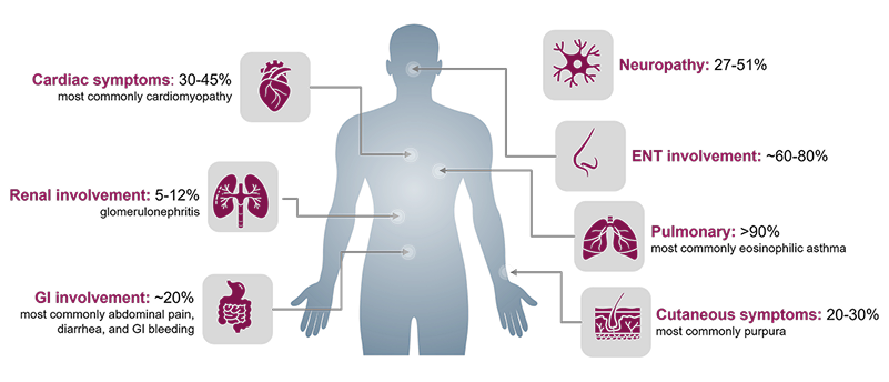 Illustration of a human body highlighting multiple organ systems affected in EGPA, including cardiac, renal, gastrointestinal, pulmonary, ENT, neurological, and cutaneous involvement. 