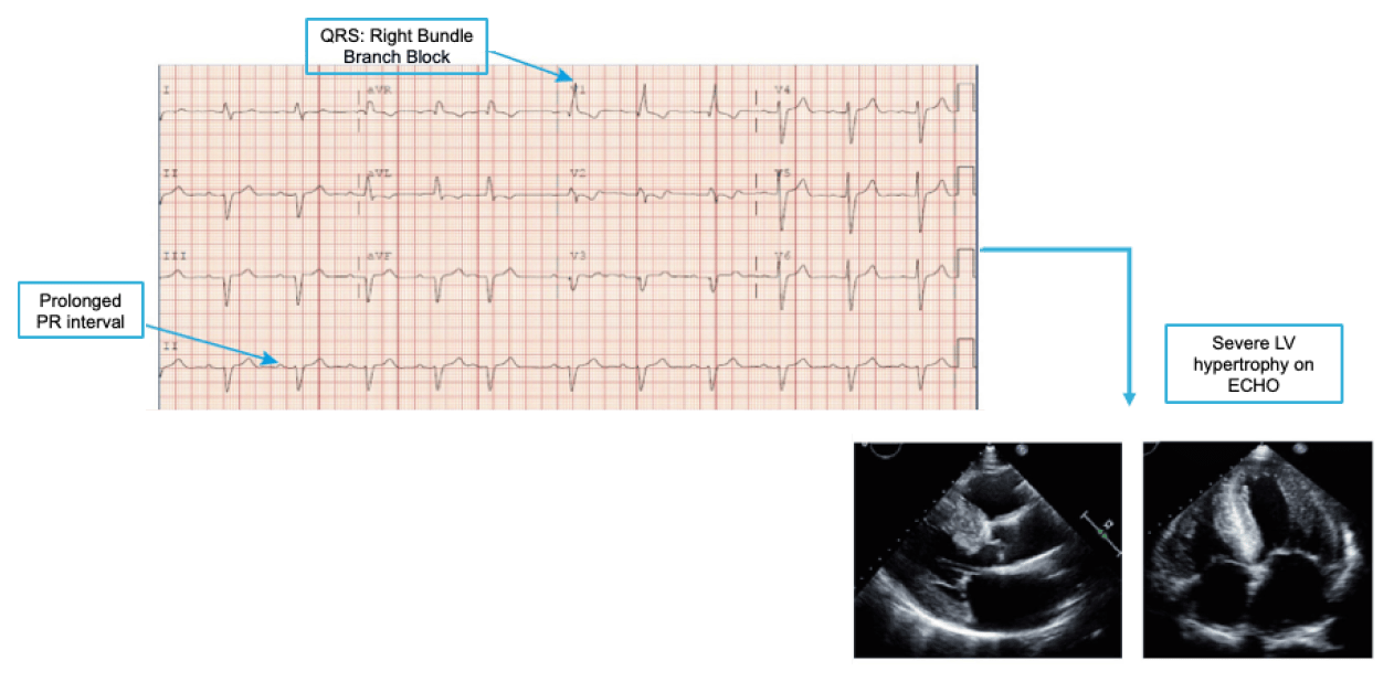 cardiomyopathy of hattr