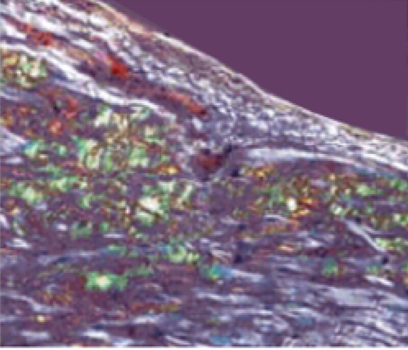 Biopsies