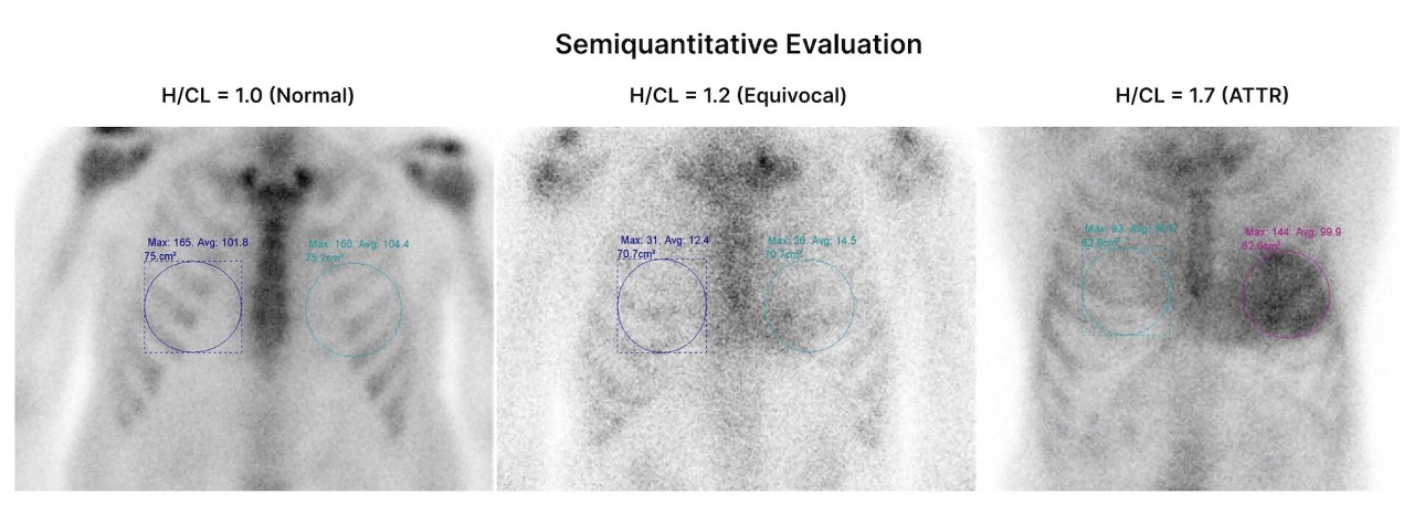 Semiquantitative evaluation