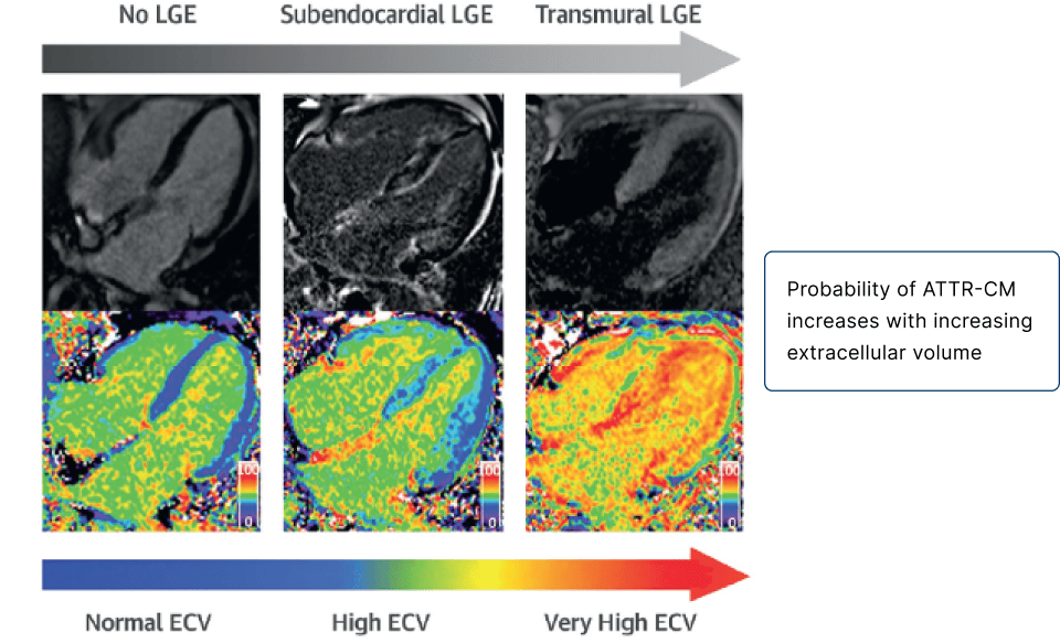 Cardiac magnetic resonance to identify amyloid with LGE in ATTR-CM